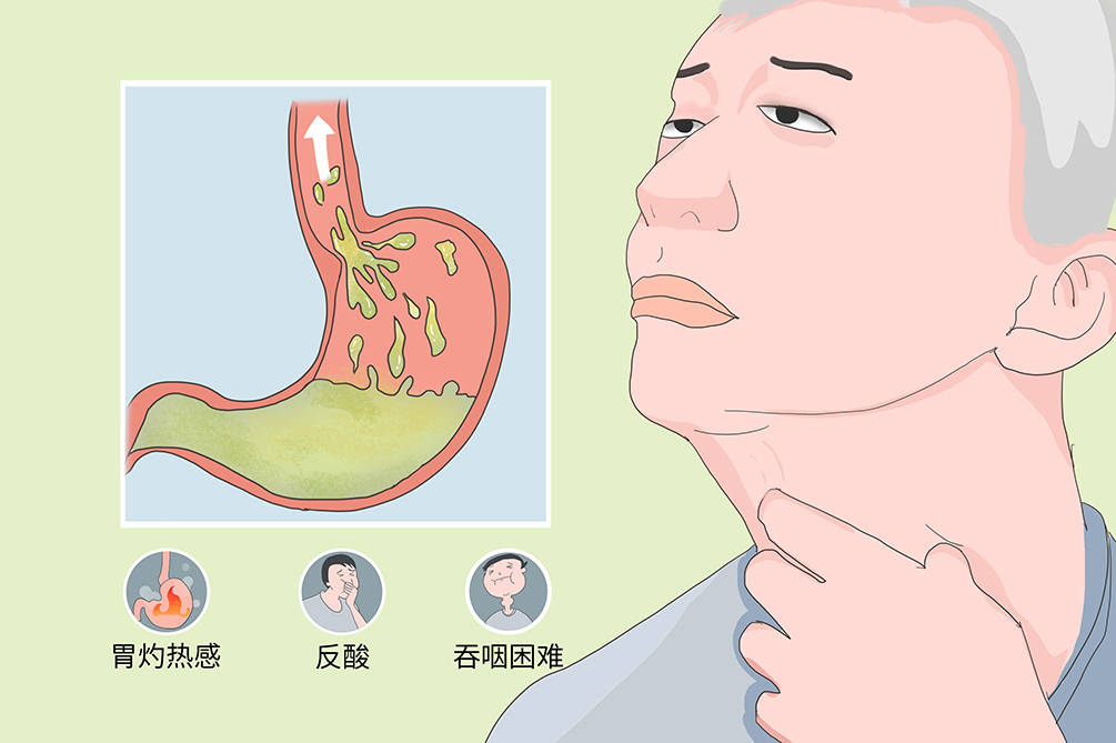 常见老年疾病科普 胃食管反流病