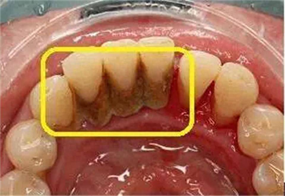 去牙结石最佳方法曝光