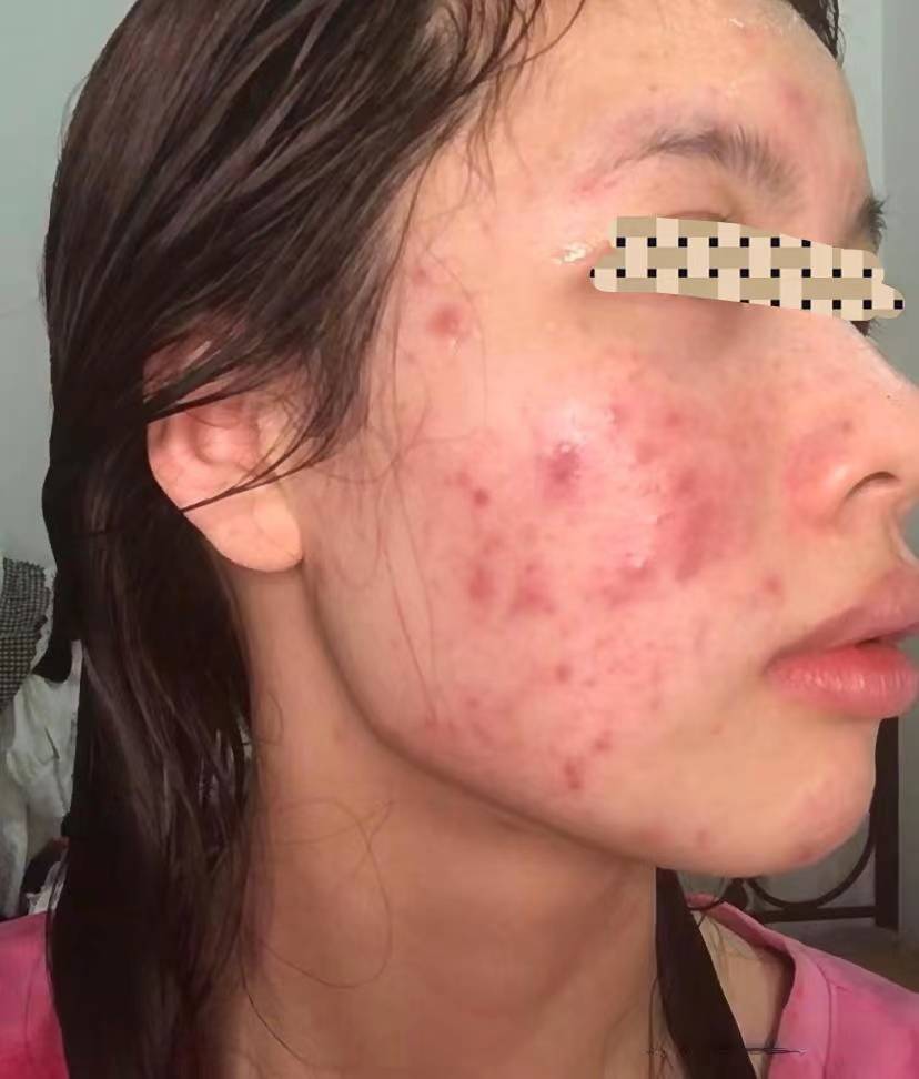 痤疮康复者自用祛痘产品分享!最好用的还是国货!用完痘痘秒没!