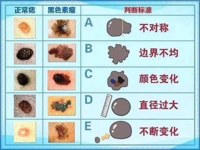 所以对于这两类痣的治疗要谨慎,如果是交界痣,根据情况进行评估,小的
