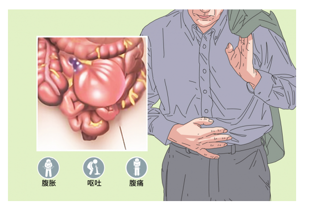 肠梗阻动画图片