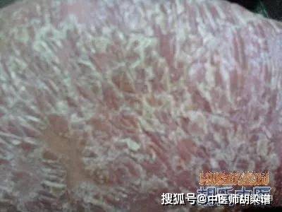 在专利药方"胡氏银屑丹"纯中药作用下的银屑癣形态观察_治疗_胡梁谱