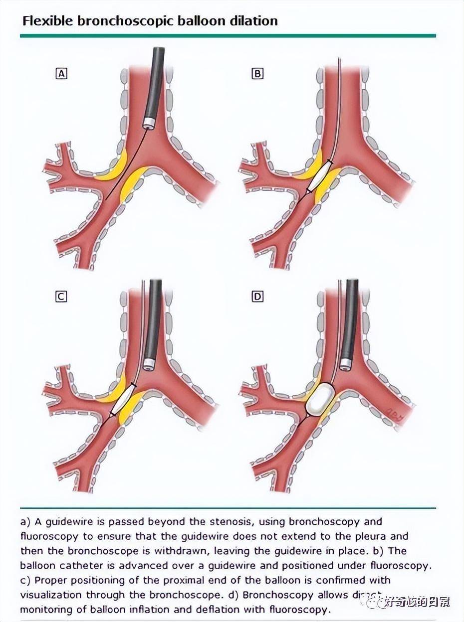 南阳六院:气道狭窄呼吸困难 支气管球囊扩张术让患者畅快呼吸_治疗