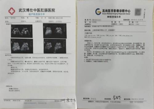 一例胆囊切除 胆总管探查术,为胆结石患者解除病痛_手术_检查_治疗