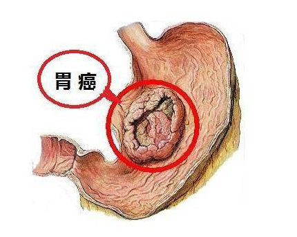这5大癌变信号,胃溃疡患者需提前知道_进行_诊断_治疗