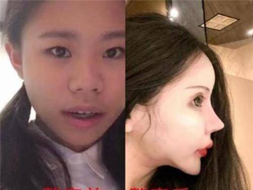 还记得13岁就整容的网红女孩吗?