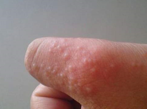 汗疱疹是怎么引起的图片