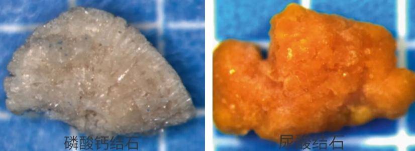 2,磷酸钙结石:是第二常见的结石类型,以碳酸磷灰石多见,多为圆形,表面
