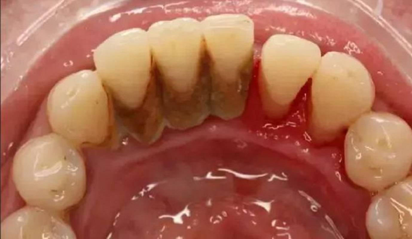 紧急曝光:如何快去除牙结石还不反复?这些方法一定不能错过!