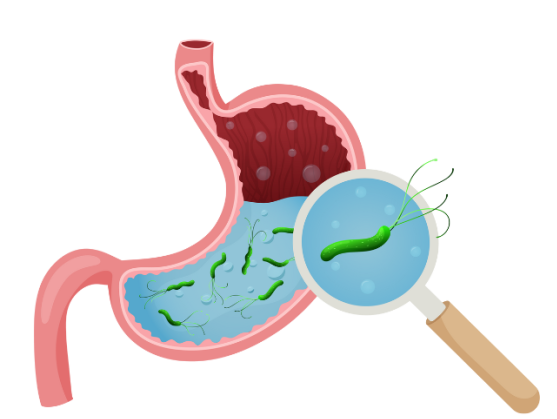 感染幽门螺杆菌,胃癌悄悄逼近?_螺旋杆菌_细菌_十二指肠