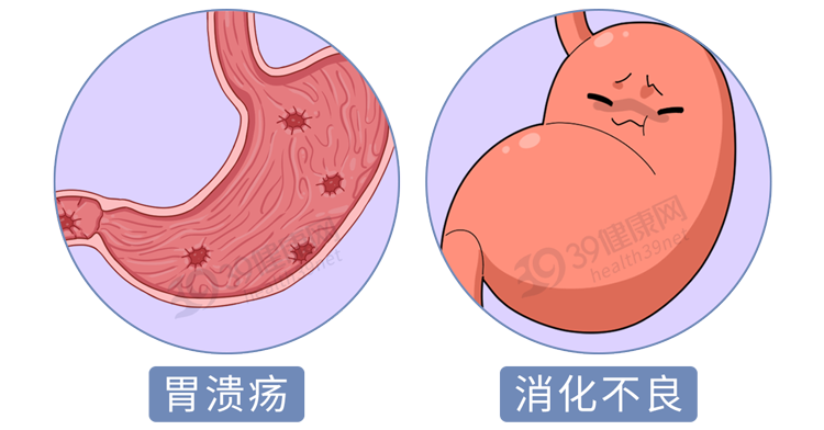 经常放屁,是肠癌征兆?