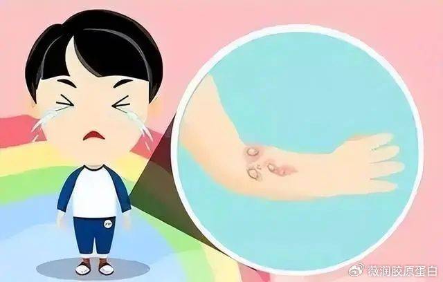 原来是炎性渗出期!Ⅲ型胶原蛋白加速创面愈合!_白细胞_局部_进行