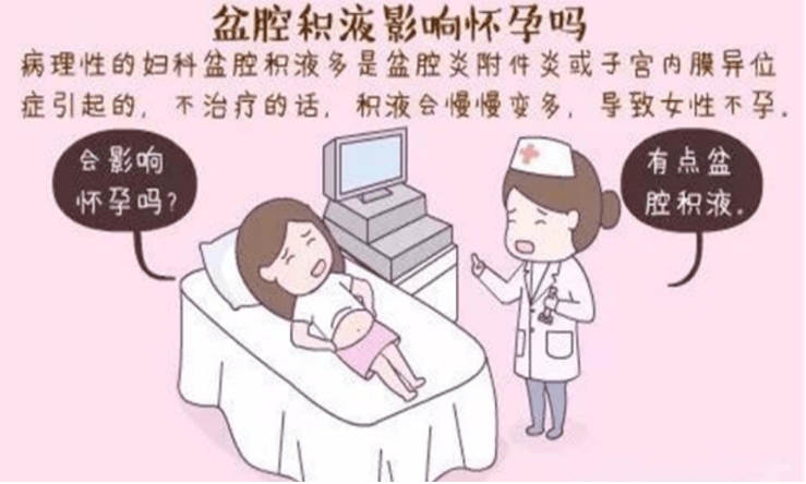 盆腔积液是什么症状表现,积液对试管有什么影响_女性_月经_患者