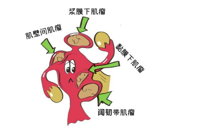 女性为什么容易长子宫肌瘤?平时尽量避免这4个行为,别太放纵了
