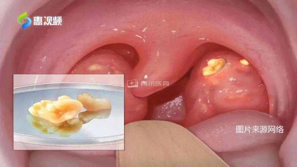 喉咙长出臭臭的玉米粒, 竟是因为……