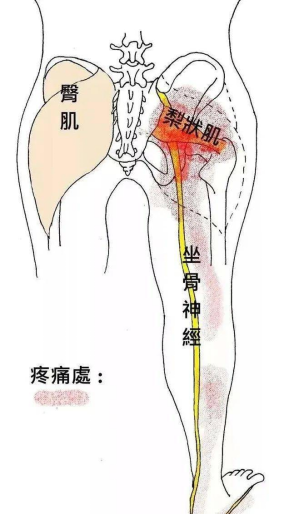 坐骨神经痛是哪里痛图图片