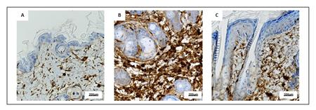 【文献解读】pdrn对银屑病皮肤症状的改善作用-循证医学研究院_炎症