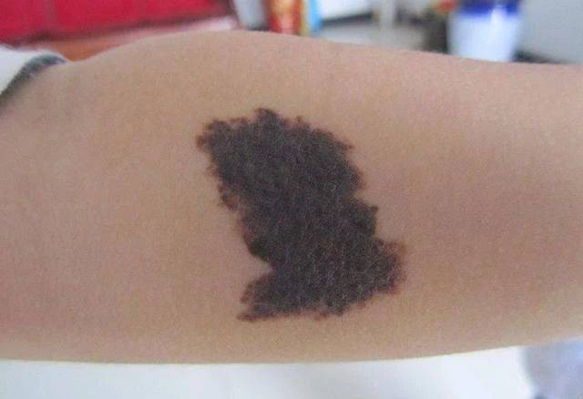 婴儿红色与黑色胎记的形成与区别_宝宝_皮肤_影响