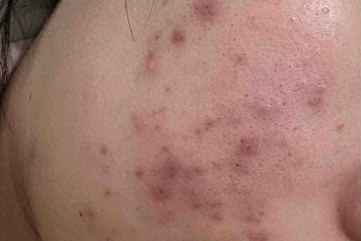 认准3这招,28天痘印秒没!_皮肤_速度_痘痘