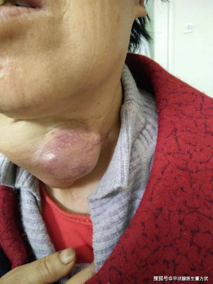得甲状腺癌的人,基本有6个"共性",来了解一下!