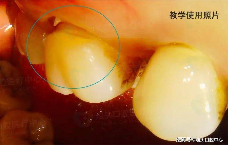 保持口腔卫生,同时关注身体的变化,当观察到牙齿颈部明显缺损或龋坏