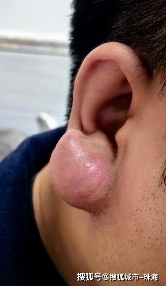 一男子狂炫20包泡椒凤爪后进了急诊