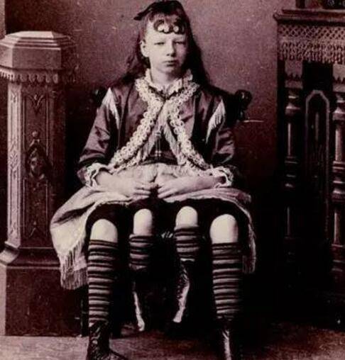 这些畸形人被马戏团包装成各种各样的角色,好比说"受上帝诅咒的女人"