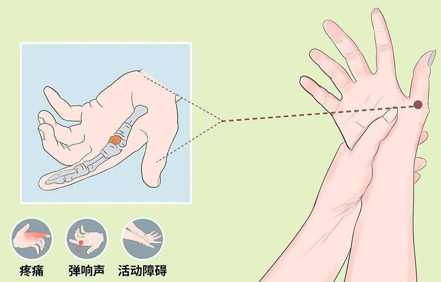 手痛手胀当心腱鞘炎找上门