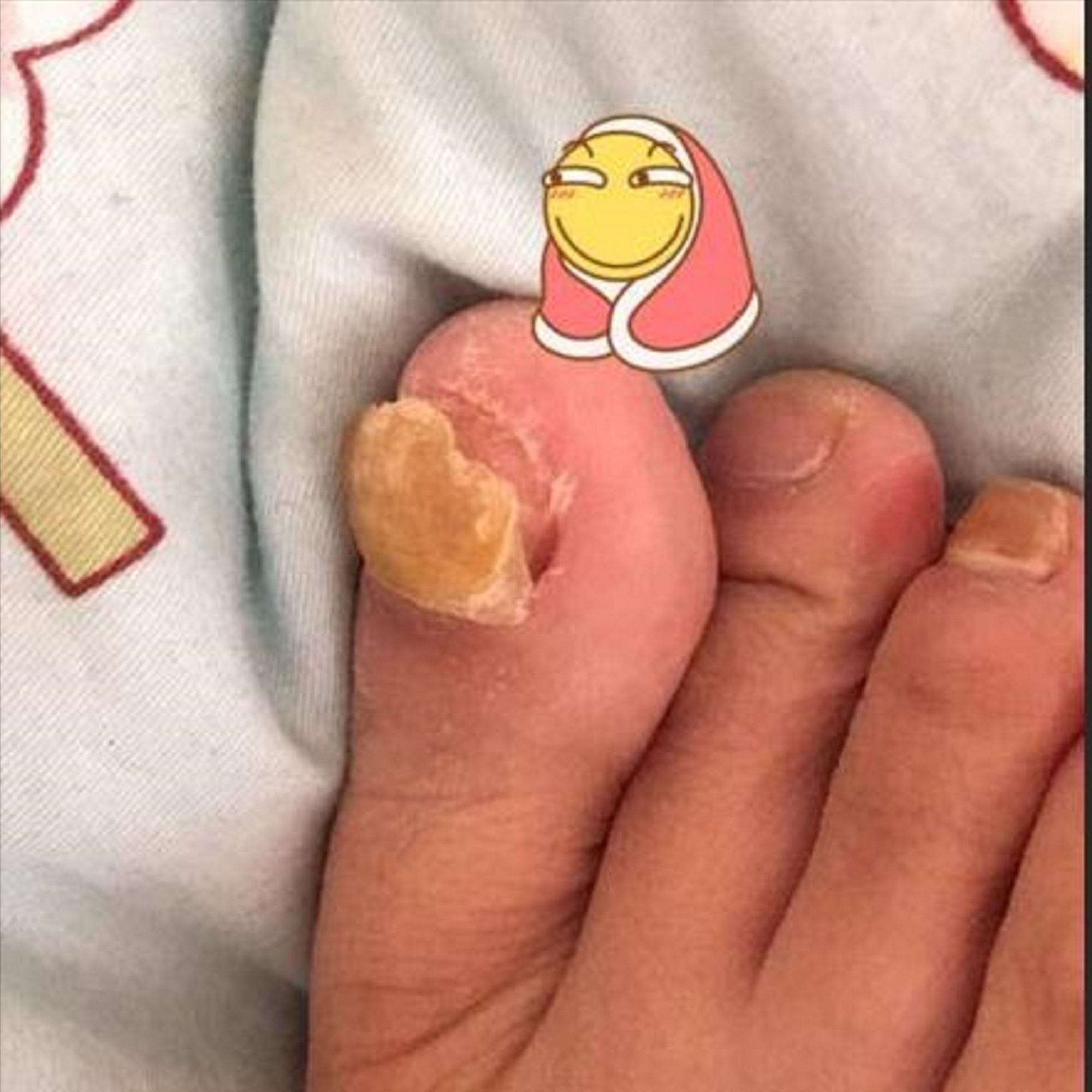 灰指甲抑菌药物大测评这几款不愧是国货之光坏甲唰唰掉