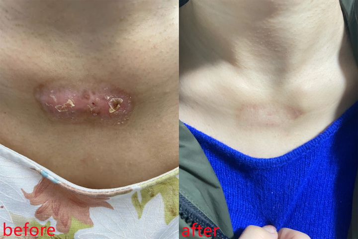 陈年老疤也能淡化过来人自用秘籍大公开方法高效又简单