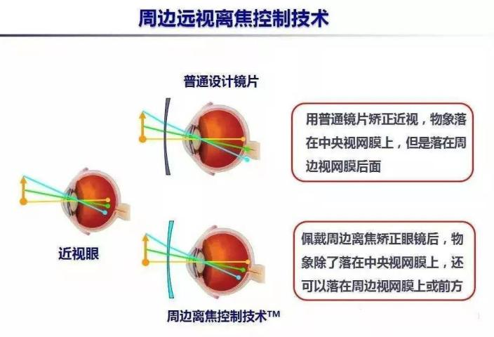 镜片