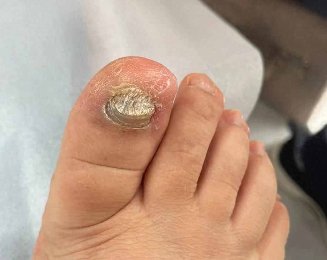 再顽固的灰指甲都能彻底根除!_效果_症状_时间