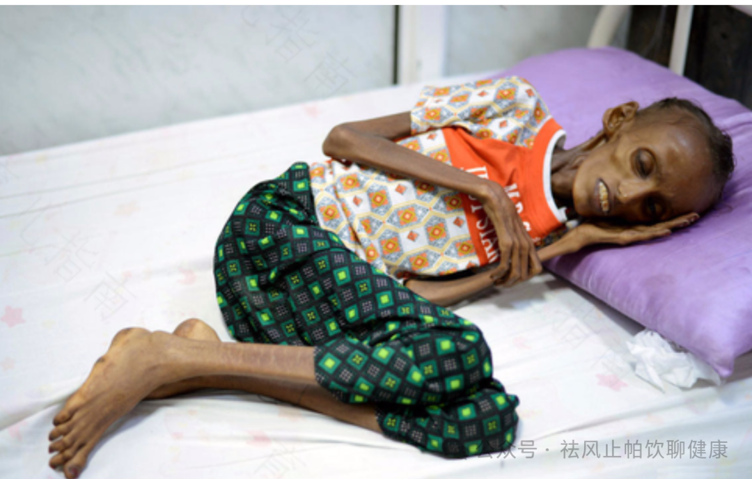 宝宝肌营养不良:家长必知的健康警示