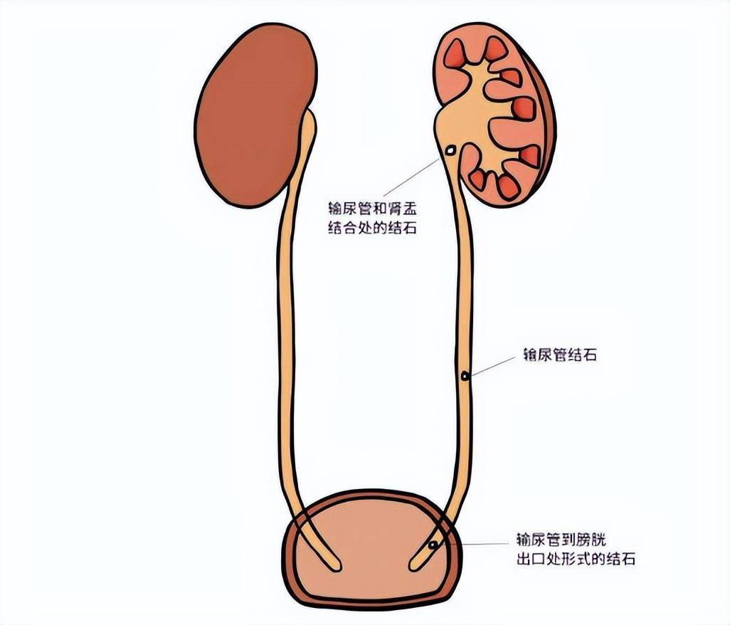 尿路结石怎么形成的图片