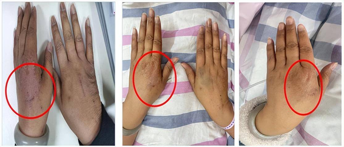 出现的手掌,足底部皮肤肿胀,片状红斑,脱屑,皲裂,双肢末梢感觉迟钝,破