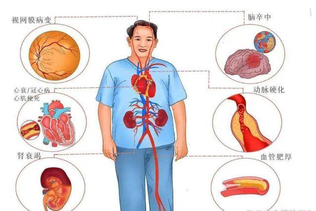 原创开始做血液透析说明了什么或许大多数人不清楚医生为你揭秘