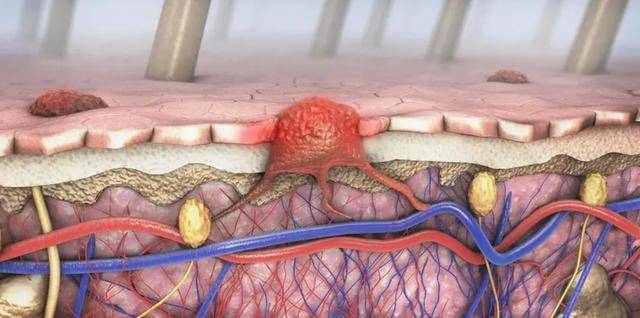 身上长"脂肪瘤"究竟要不要切除?不妨听听医生的说法,涨知识了_症状_生