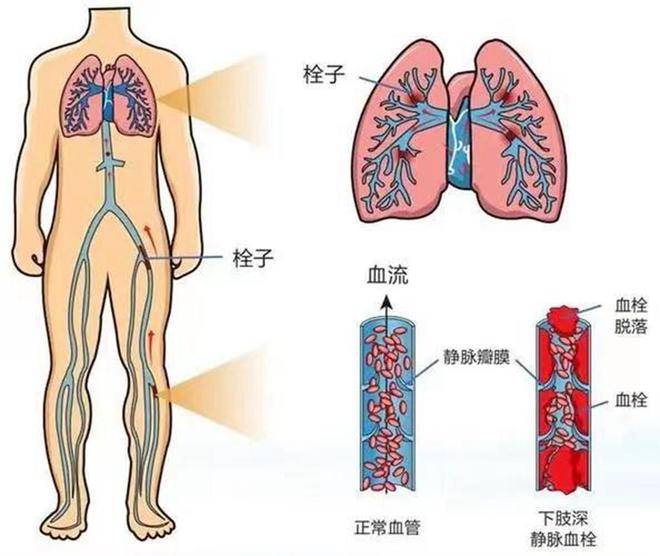 女子大面积肺栓塞5次心跳骤停 常德一医ecmo护航助她起死回生