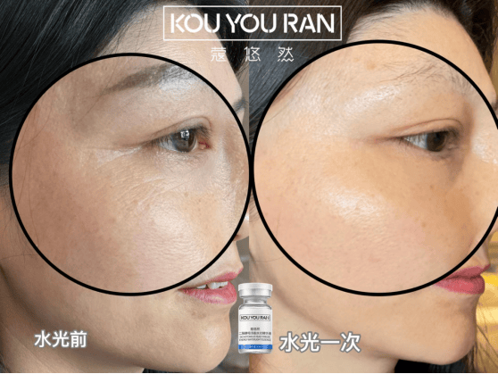 蔻悠然:科技与美容的完美结合,揭秘无针水光的崛起_用户_技术_效果