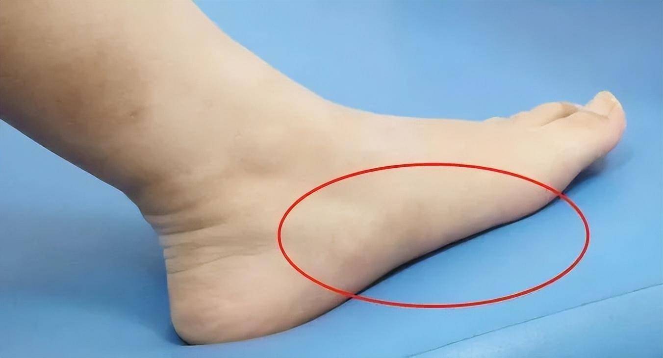 赏花回来后,脚趾头不敢碰_阿姨_鞋子_症状