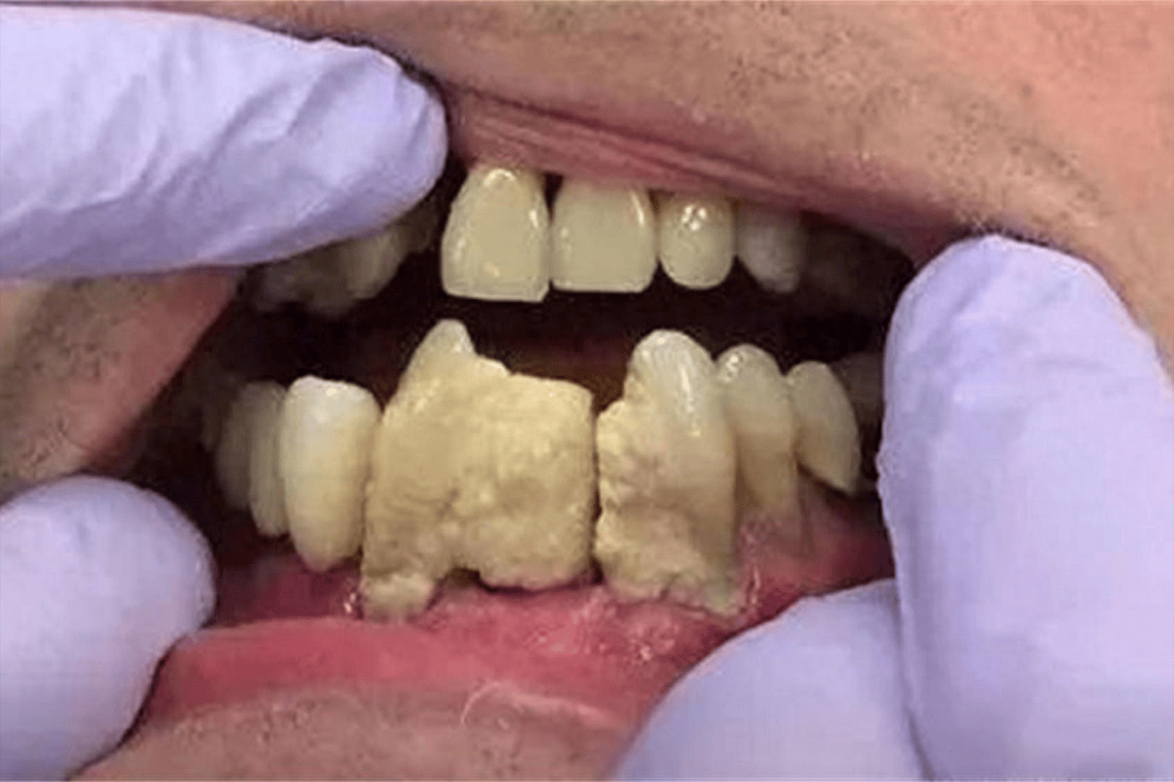 方法原来竟这么简单!_牙齿_牙粉_食物残渣