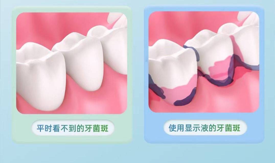 深圳牙科牙菌斑