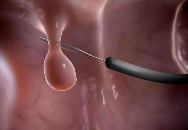 原创为何多数人不愿做肠镜一次肠镜有效期是多久看完涨知识了