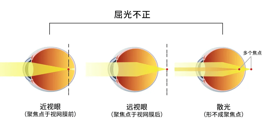 什么是弱视分类有哪些(孩子弱视怎么办必须戴眼镜吗)