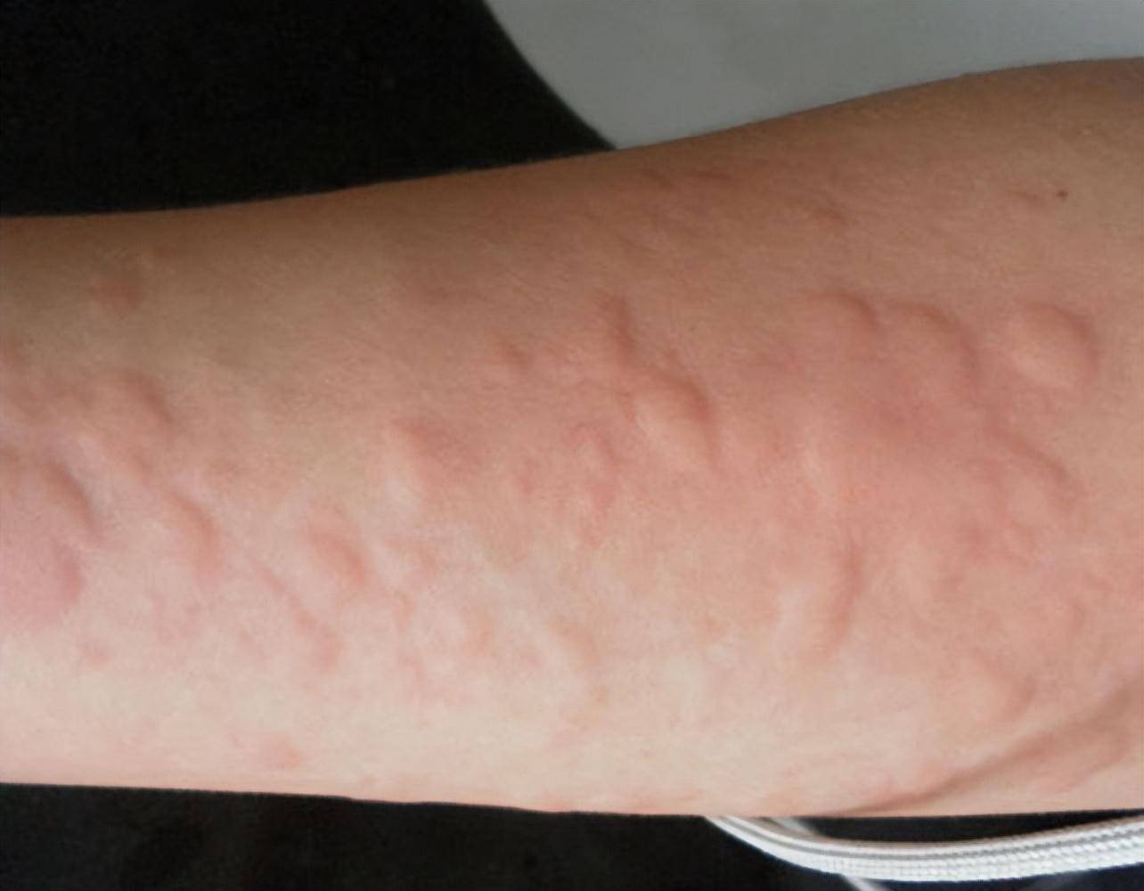 过敏性休克,为什么不用肾上腺素?