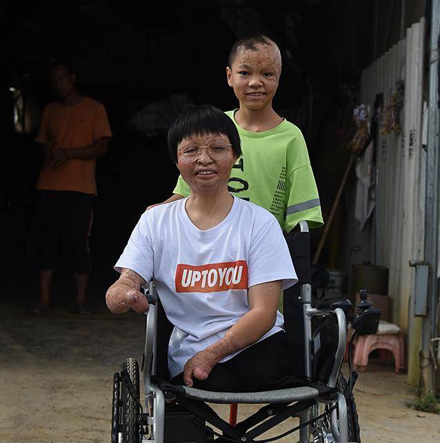 原创13年前她为救弟弟烧伤失去双腿双手13年后588分考上大学