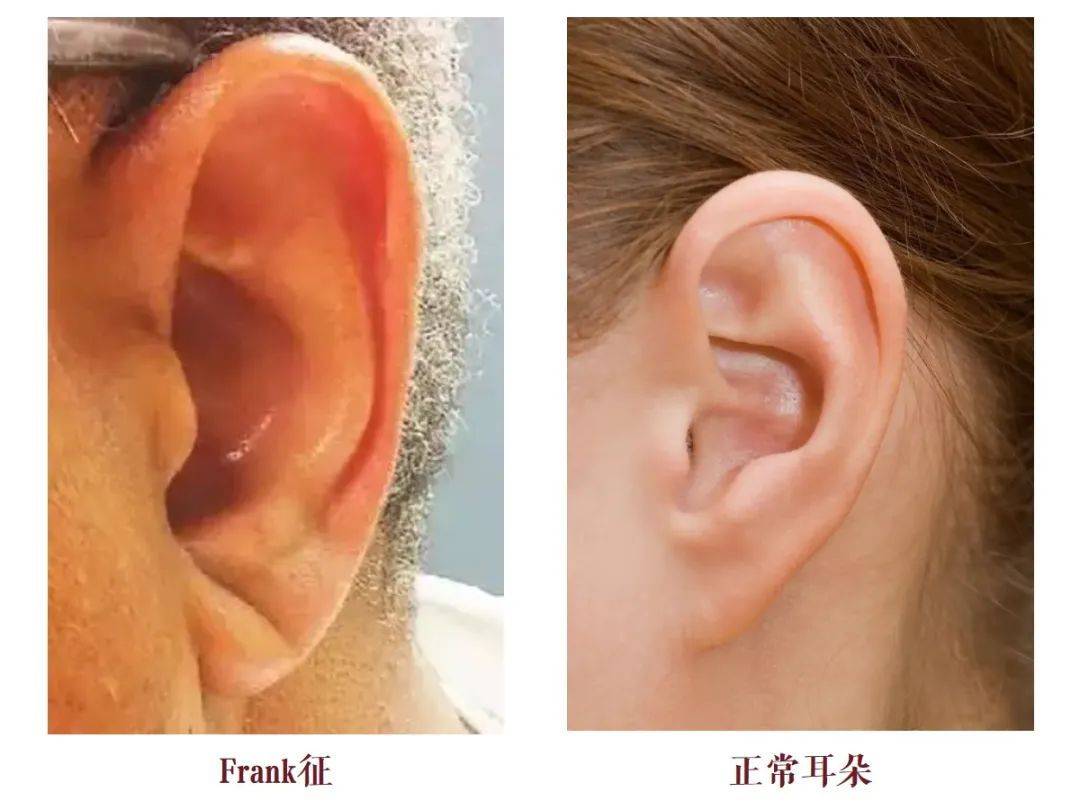 问止心脏病专科心梗发作的4大征兆和1个救命绝招