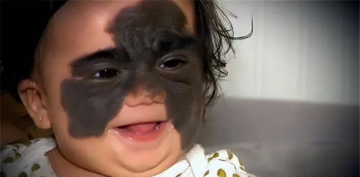 原创还记得天生胎记酷似蝙蝠侠的女婴吗6次整容后仍在治疗