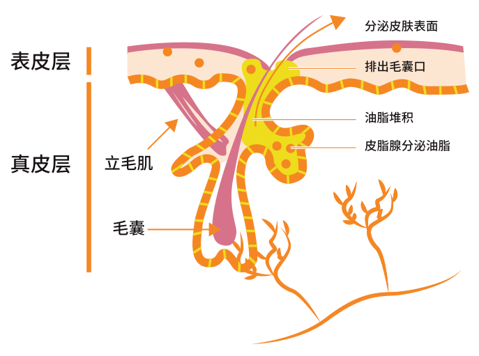 首先,我们要了解青春痘也称为痤疮,是由于毛囊皮脂腺发炎导致的一种