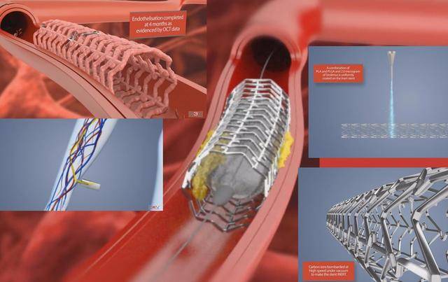 原创国内将逐渐停止心脏支架手术做完人就废了医生道出真相